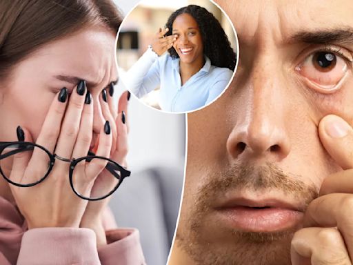 Bizarre treatment may be better for dry eyes than eye drops: study