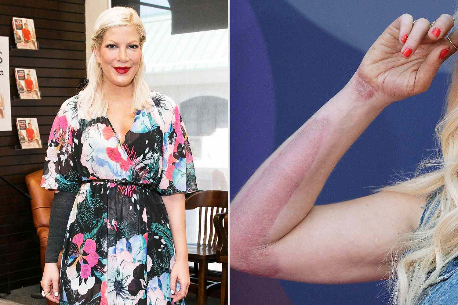 Tori Spelling Says She's 'Wearing My Thigh on My Arm' from Skin Graft After Falling on a Hot Hibachi Grill