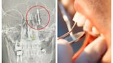 土耳其男接受植牙險喪命 牙醫太用力「螺絲直插頭骨」場面驚嚇