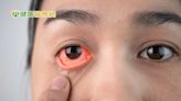 10歲童高燒、眼睛紅竟是「眼窩蜂窩組織炎」 微創手術治療救回一命