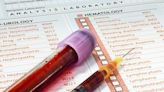 US County-Level Study Shows Benefits of PSA Screening