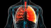 Arcturus Therapeutics’ ARCT-032: Might Be The Next Breakthrough In Cystic Fibrosis (ARCT)