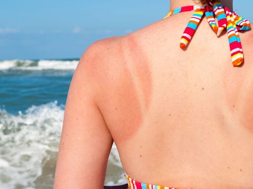 Does Your Sunburn Require Medical Attention? Here Are The 2 Signs It Does.