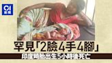 印度婦誕畸胎「2臉4手4腳」 出生僅5小時死亡原因慘痛