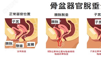 子宮膀胱脫垂有解方，善用「陰道子宮托」，生活品質大加分