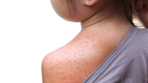 Measles outbreak prompts health warning