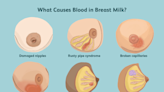 Is It Safe to Breastfeed If There Is Blood In Breast Milk?