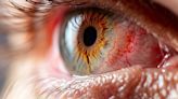 Por que se orogina el nistagmo, la afección que produce movimientos rápidos, involuntarios y rotatorios de los ojos