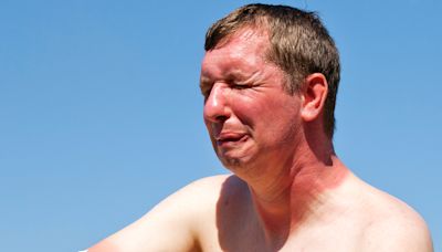 My unorthodox trick will drastically reduce discomfort when you get a sunburn