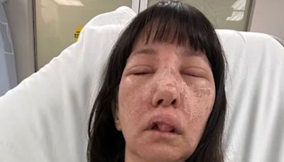 Mom attacked by venomous spiders while cleaning & left with disturbing injuries