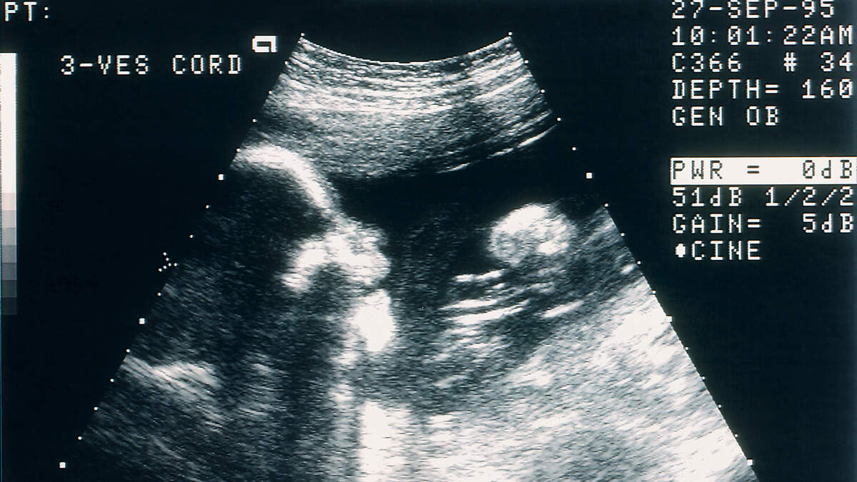 Q&A – Florida’s Amendment 4, What’s the Definition of Fetal Viability? | 1290 WJNO