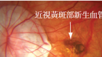 視界雲霧再現？ 成年後近視度數居然逆襲眼睛健康何去何從？