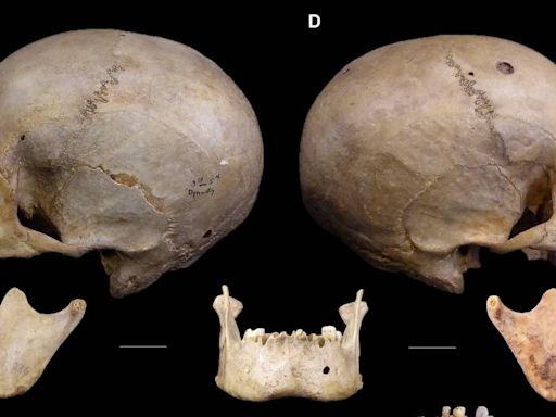 El cráneo de 4.000 años de antigüedad que revela cómo los egipcios trataron de operar el cáncer