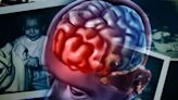 TBI Linked to Higher Schizophrenia and Bipolar Disorder Risk