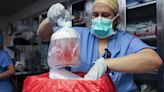 Pig kidney transplant patient dies 7 weeks after groundbreaking operation