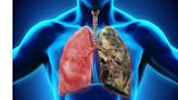 Un estudio alerta de que los pacientes con crisis respiratorias por EPOC deben usar anticoagulantes