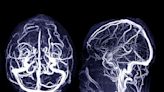 What is a cerebral aneurysm and what are the signs?