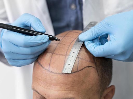 Alopecia masculina: ¿A qué edad es mejor hacerse un trasplante de pelo?