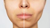 What is buccal fat removal? Experts explain the real effects