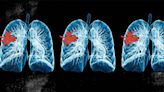 Asthma, COPD: Trial shows benefits of diagnosing conditions early
