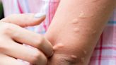 ¿Cuánto tiempo puede durar una alergia en la piel?