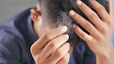 Estos son los peligros que te exponés por no lavarte el pelo en varios días, según una dermatóloga