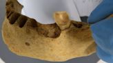 Ancient teeth rarely have a cavity-causing bacteria commonly seen today. A new study reveals why
