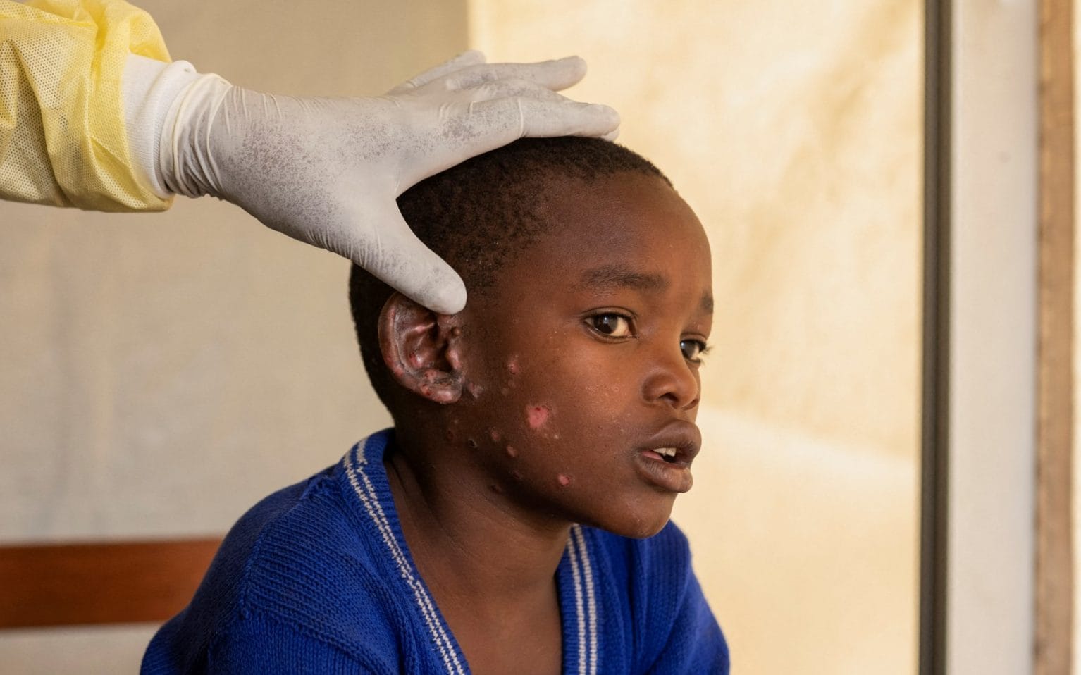 Africa’s worsening mpox outbreak can no longer be ignored – here’s what needs to be done