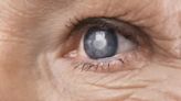 When do you know it’s time to have cataract surgery?