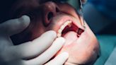 Do we need our wisdom teeth removed? Experts say this common procedure may be unnecessary