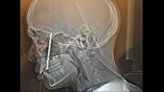 ‘Defective’ nail gun shoots nail through carpenter’s tongue and head, lawsuit says