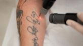 Quand les regrets des tatoués font le bonheur des médecins esthétiques