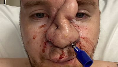 Epilepsy sufferer 'heartbroken' after nose ripped off by pet dog