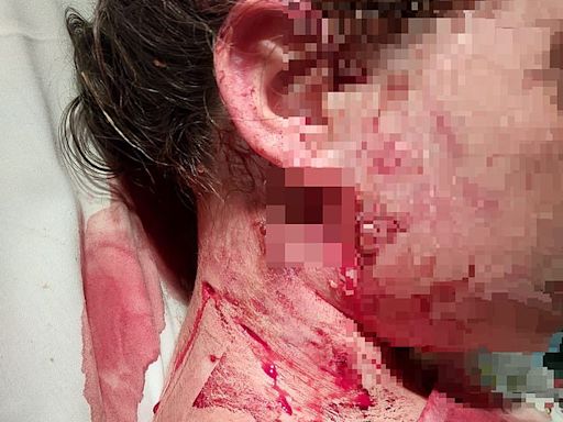 Schoolgirl, ten, rushed to hospital after being mauled by XL Bully