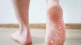 How Plantar Warts Are Treated