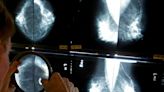 40 the new target age for breast cancer screening: Canadian Cancer Society