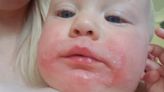 Toddler's 'chickenpox' morphs into horror blisters forcing docs to remove skin