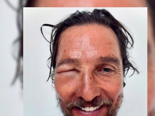 Matthew McConaughey Suffers From Severe Bee Stunt; Fans Wish Speedy Recovery - News18