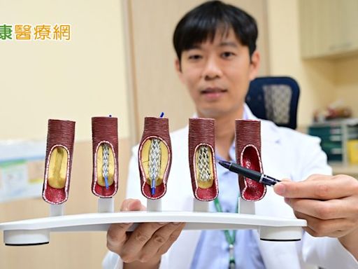 婦反覆胸痛心電圖、Ｘ光找不出異狀 「1檢查」秒見右冠狀動脈99%阻塞