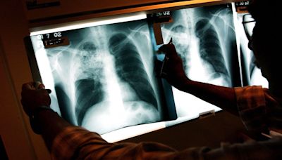 Tuberculosis in California: Outbreak declared in Long Beach, 1 dead, 9 hospitalized