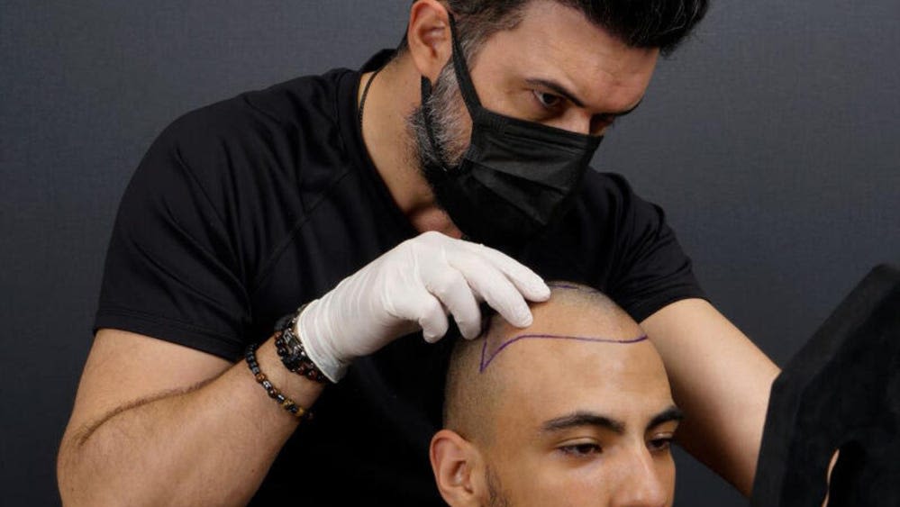 Hair Transplants in Turkey: What Makes the Country a Top Choice?