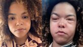 Jeniffer Nascimento choca ao aparecer com rosto inchado por reação alérgica