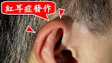 低頭族頭痛耳紅如火燒 恐是頸性紅耳症候群