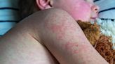 Urgent health warning issued as measles rampages through Europe