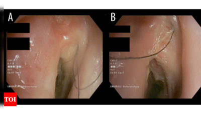 Hair grows in Austrian man's throat after 30 years of smoking - Times of India