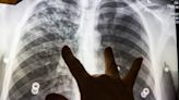 Pandemic disruptions caused 7,000 excess TB deaths in Europe, says report