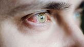 What Is Eye Syphilis? The Severe Symptom Doctors Are Seeing amid the STD Epidemic