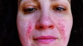 Woman finally finds cure for skin condition - with kitchen ingredient