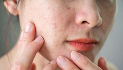 If You Notice This Kind of Rash on Your Skin, Seek Medical Care ASAP