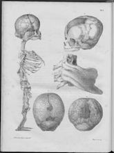 Osteogenesis imperfecta